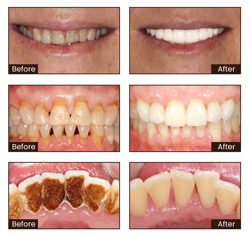 BodyAccel Whitening Toothpaste